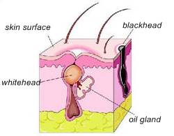 what causes whiteheads